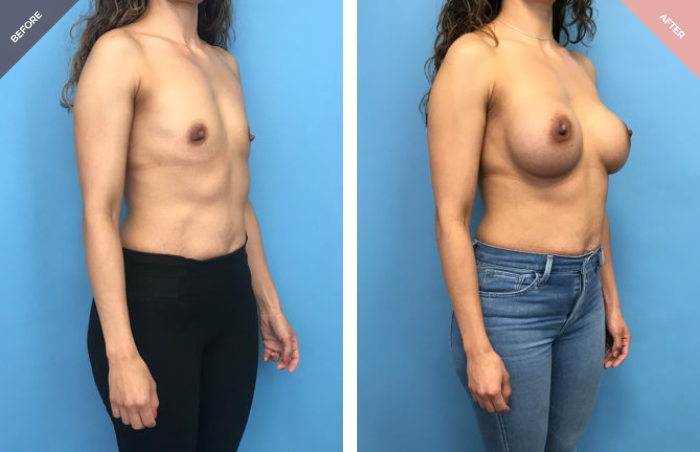 Breast Augmentation with Implant
