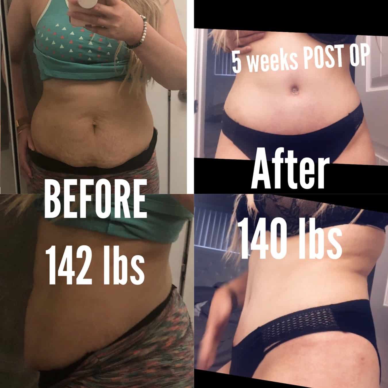 Before photo showing woman's abdomen area prior to cosmetic surgery, wearing exercise clothing.