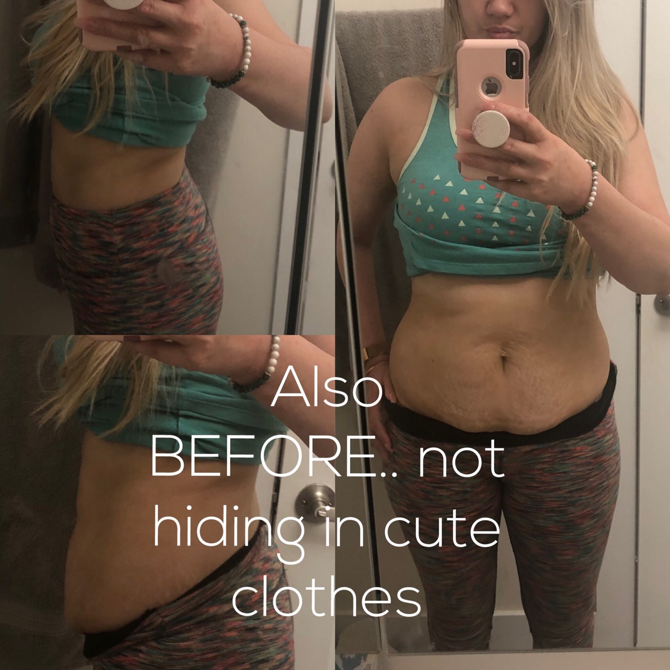 Before photo showing woman's abdomen area prior to cosmetic surgery, wearing exercise clothing.