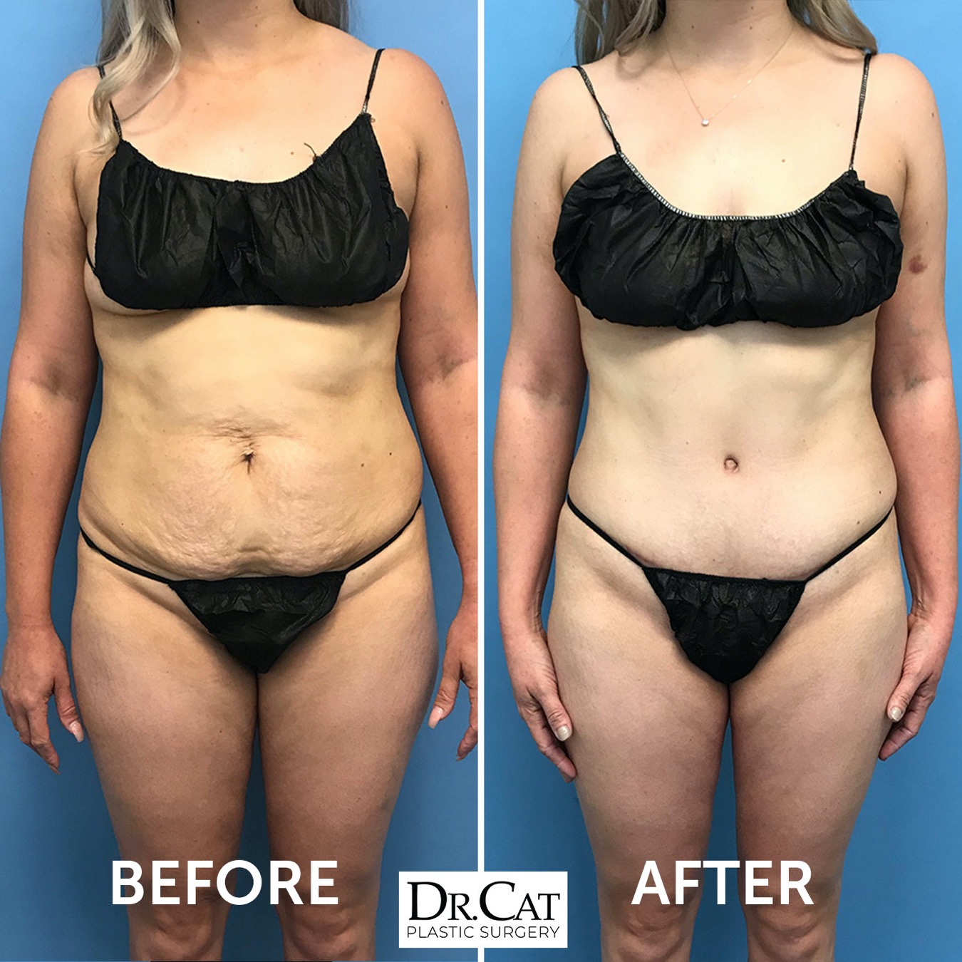 Dr. Cat Plastic Surgery Beverly Hills
