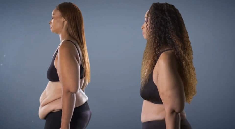 Two women in side profile showing abdominal transformation before and after cosmetic surgery.
