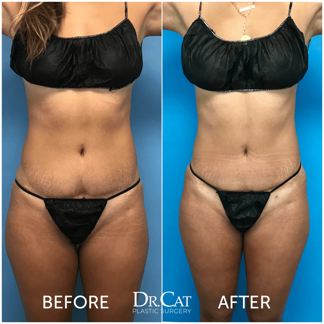 Mini tummy tuck vs full: before and after a mini tummy tuck by Dr. Cat, loose skin below the navel removed, navel unchanged