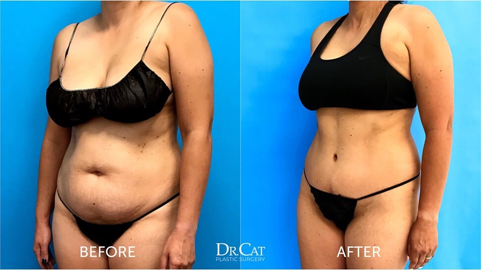 Tummy tuck recovery guide - Dr. Cat Beverly Hills