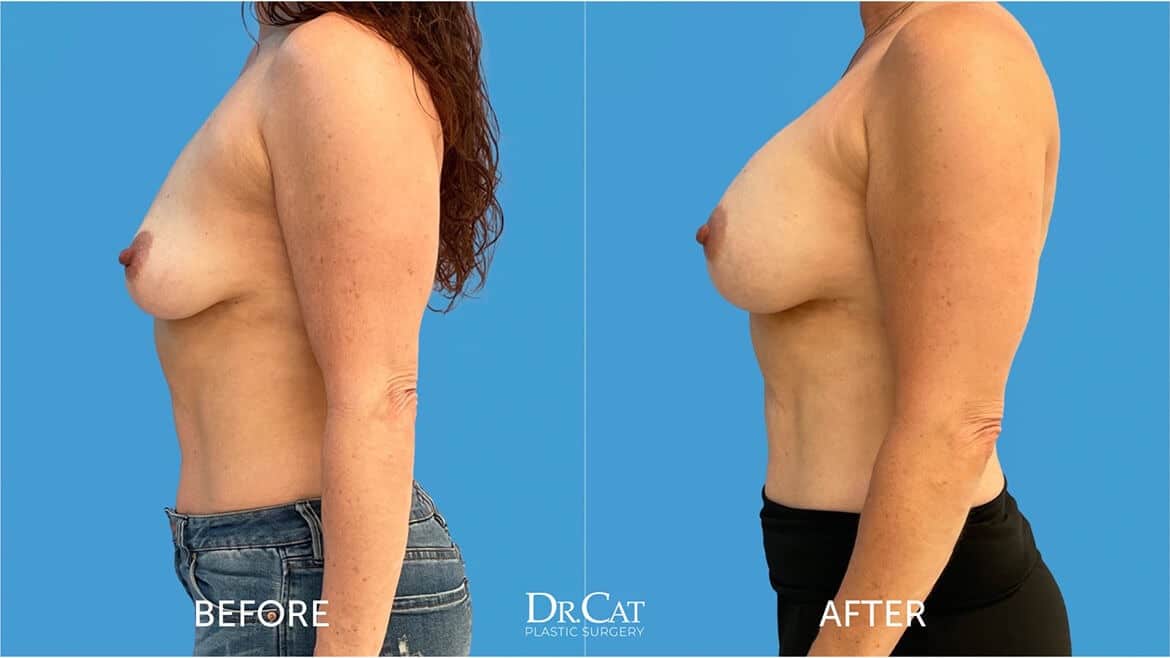 Saline breast implant options and results at Dr. Cat Beverly Hills