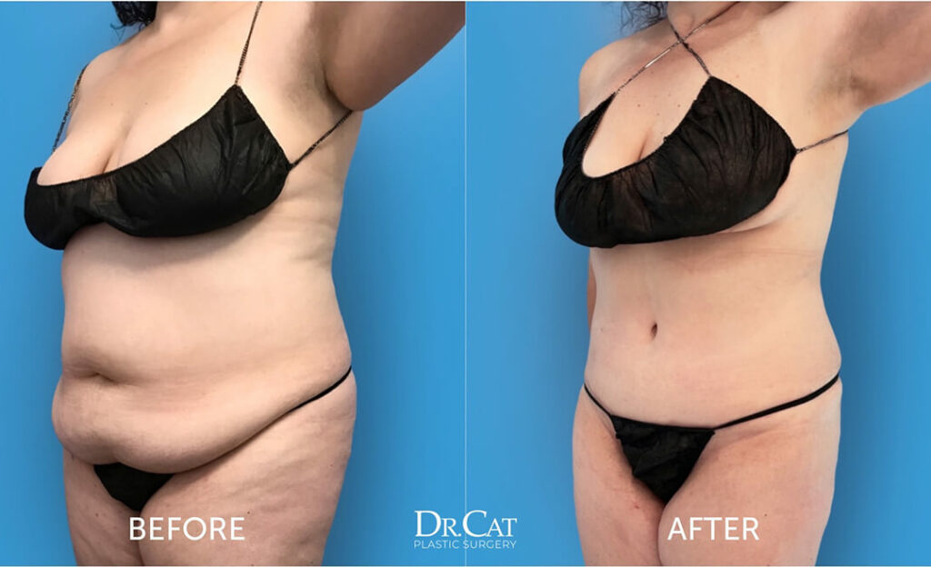 Before and after images of tummy tuck surgery performed by Dr. Cat, showing substantial reduction of abdominal fat and improved waistline.
