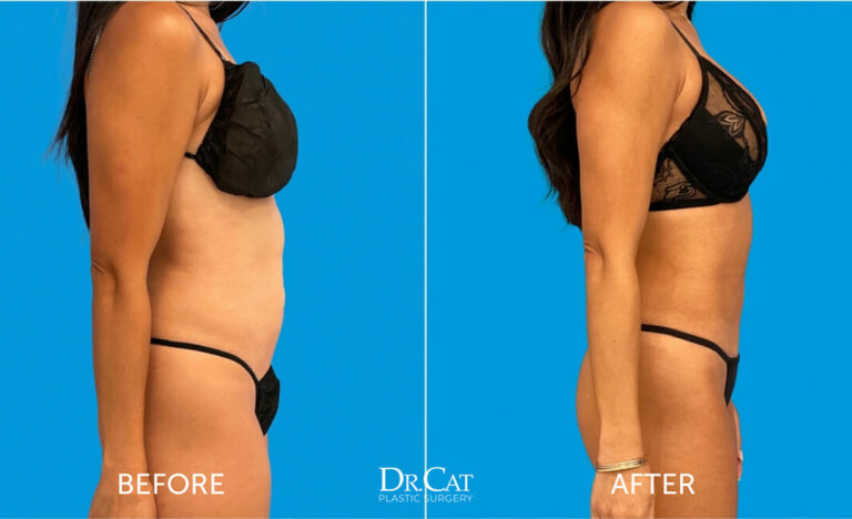 Before and after side-profile images demonstrating results of a tummy tuck procedure by Dr. Cat, showing improved abdominal tone and contour.