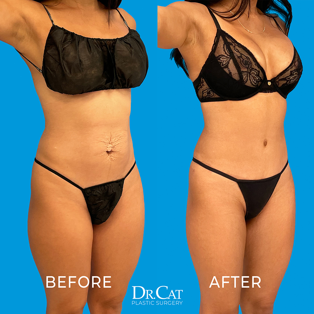 Dr. Cat Plastic Surgery Beverly Hills