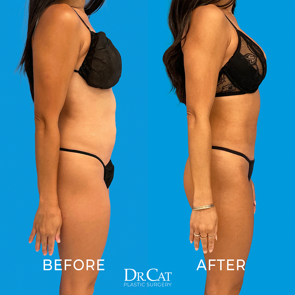 Dr. Cat Plastic Surgery Beverly Hills