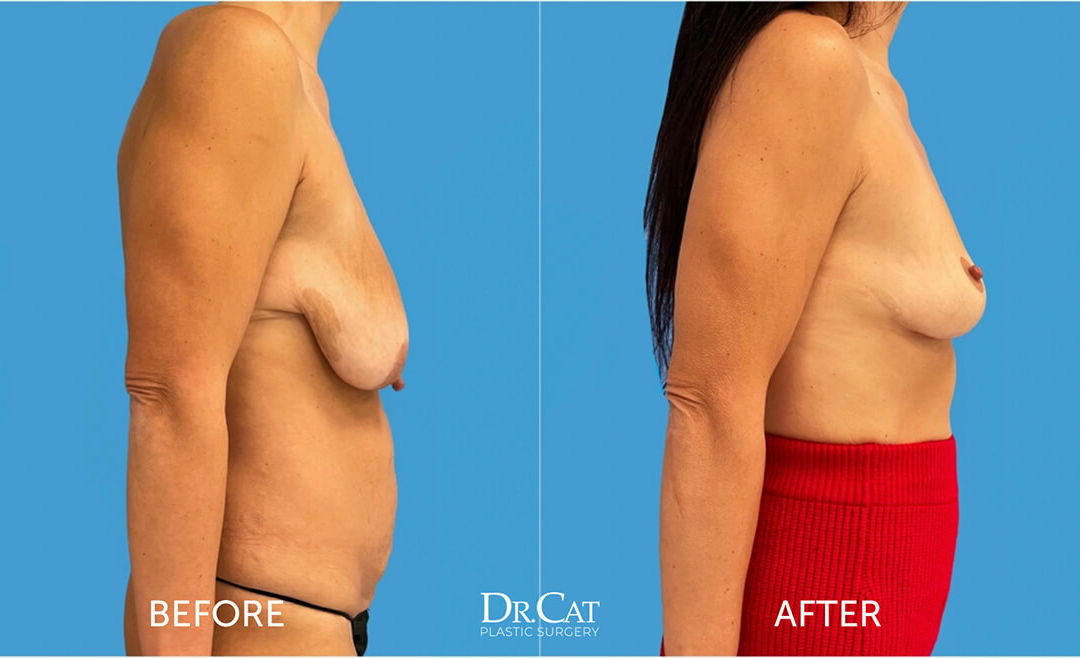 Before and after comparison of breast lift surgery showing improvement in breast sagging.