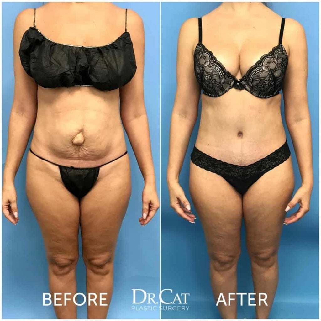 Tummy tuck cost in Beverly Hills patient results at Dr. Cat Plastic Surgery