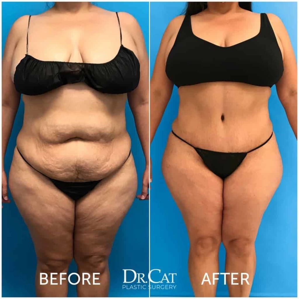 Tummy tuck pricing and abdominoplasty cost guide at Dr. Cat Beverly Hills