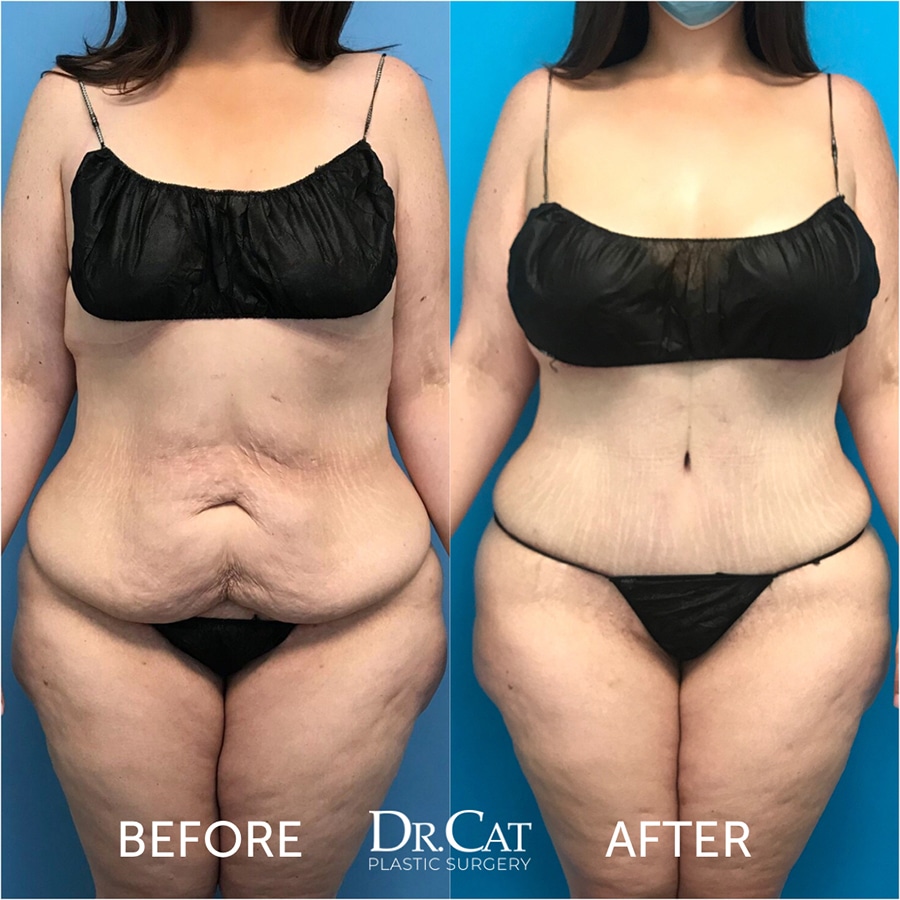 Dr. Cat Plastic Surgery Beverly Hills