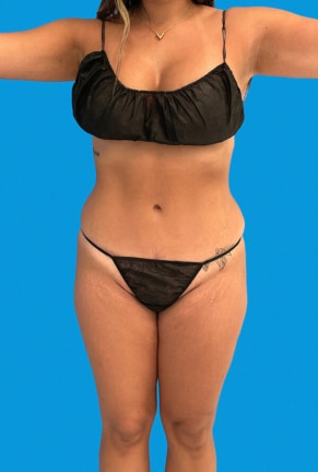 Front view of patient's results after cosmetic treatment at Beauty by Dr. Cat