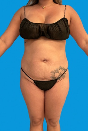 Front view of female patient in black underwear before body sculpting procedure.