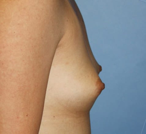 Plastic surgery patient results gallery - Dr. Cat Beverly Hills
