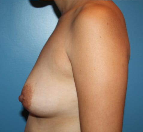 Plastic surgery patient results gallery - Dr. Cat Beverly Hills