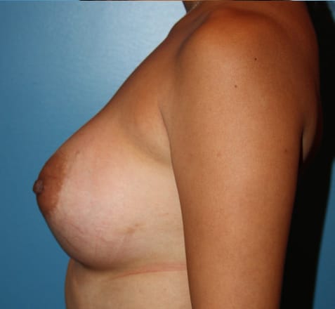 Plastic surgery patient results gallery - Dr. Cat Beverly Hills