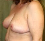 Plastic surgery patient results gallery - Dr. Cat Beverly Hills