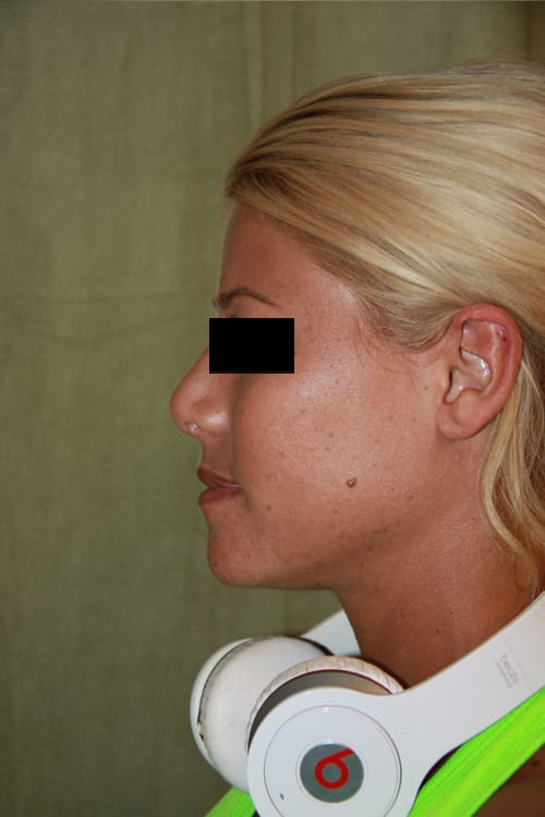 Plastic surgery patient results gallery - Dr. Cat Beverly Hills