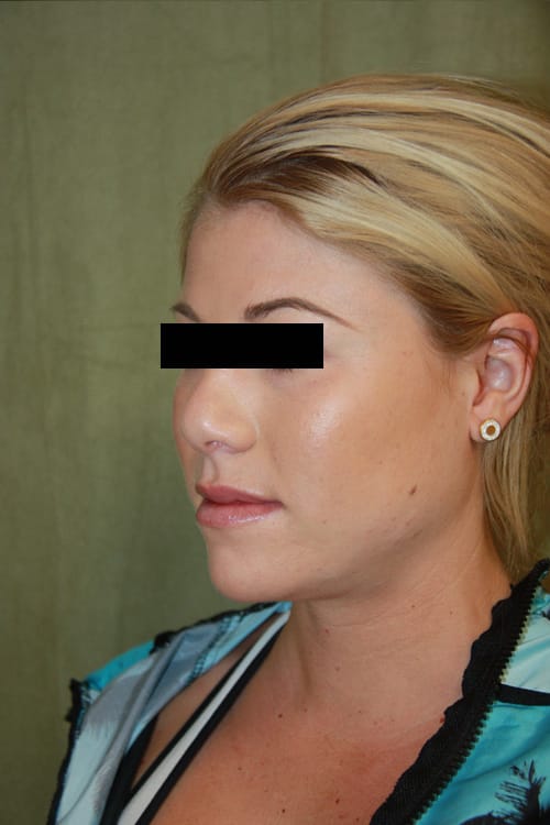 Plastic surgery patient results gallery - Dr. Cat Beverly Hills