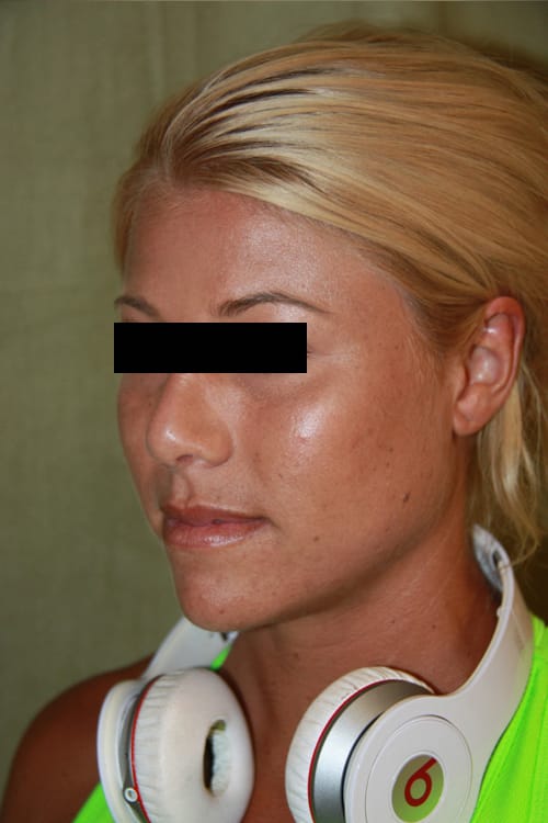 Plastic surgery patient results gallery - Dr. Cat Beverly Hills