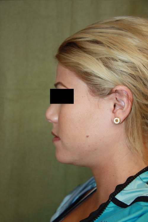 Plastic surgery patient results gallery - Dr. Cat Beverly Hills