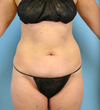 Plastic surgery patient results gallery - Dr. Cat Beverly Hills