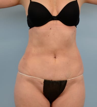 Plastic surgery patient results gallery - Dr. Cat Beverly Hills