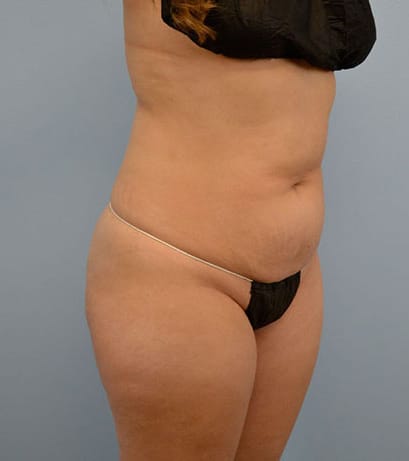Plastic surgery patient results gallery - Dr. Cat Beverly Hills