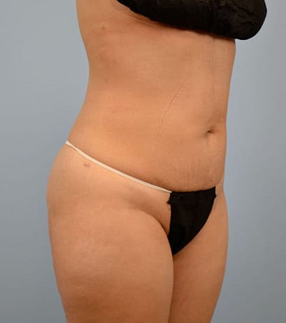Plastic surgery patient results gallery - Dr. Cat Beverly Hills