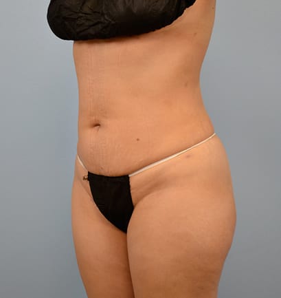 Plastic surgery patient results gallery - Dr. Cat Beverly Hills