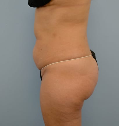 Plastic surgery patient results gallery - Dr. Cat Beverly Hills