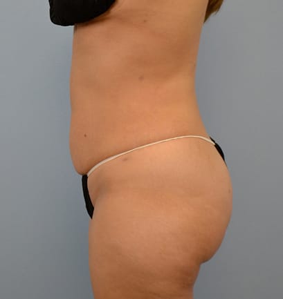 Plastic surgery patient results gallery - Dr. Cat Beverly Hills