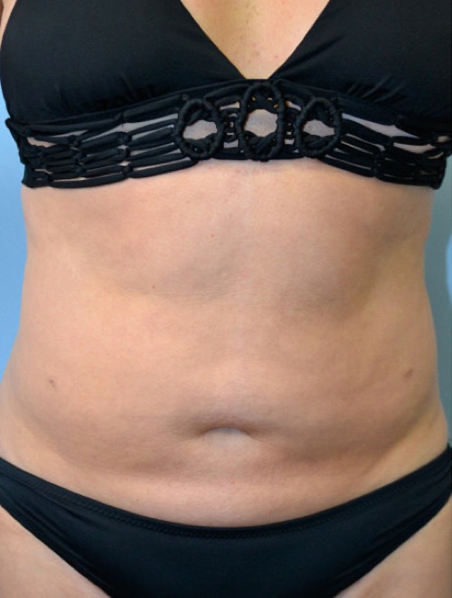 Plastic surgery patient results gallery - Dr. Cat Beverly Hills