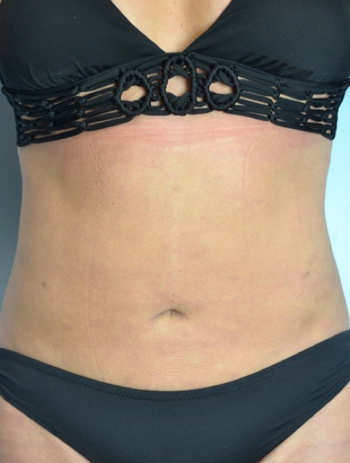 Plastic surgery patient results gallery - Dr. Cat Beverly Hills