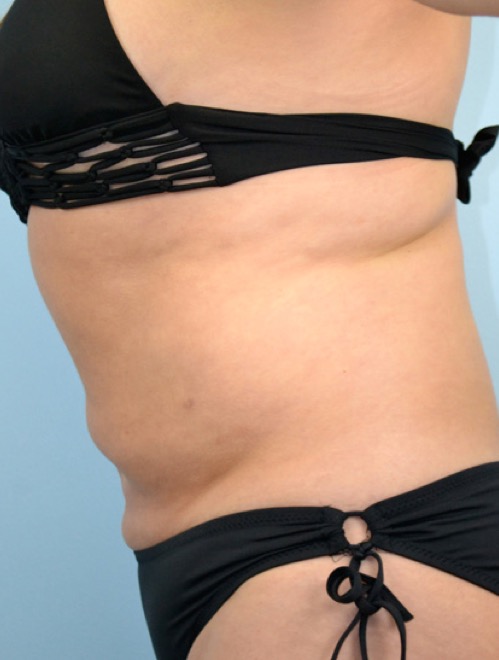 Plastic surgery patient results gallery - Dr. Cat Beverly Hills