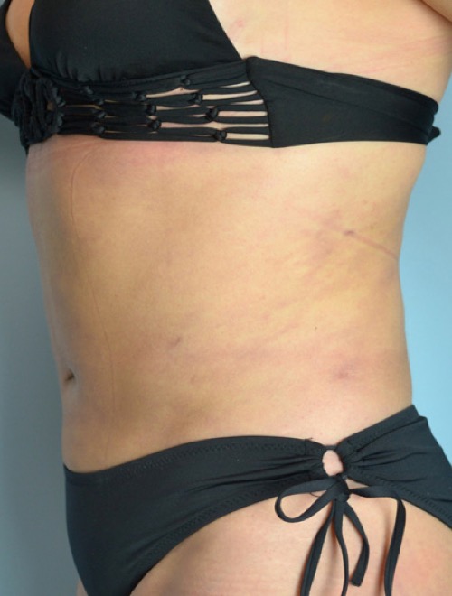 Plastic surgery patient results gallery - Dr. Cat Beverly Hills