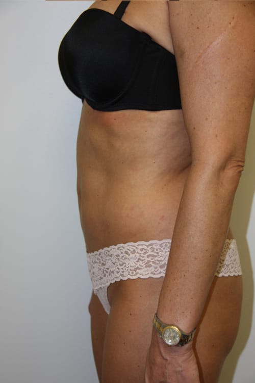 Plastic surgery patient results gallery - Dr. Cat Beverly Hills