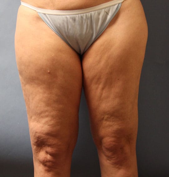Plastic surgery patient results gallery - Dr. Cat Beverly Hills