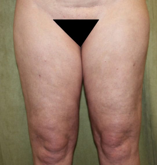 Plastic surgery patient results gallery - Dr. Cat Beverly Hills