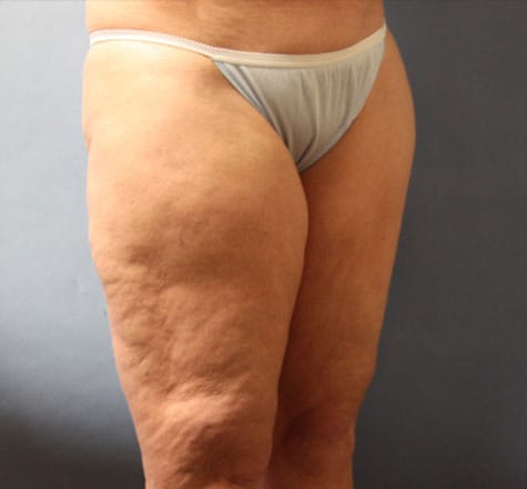 Plastic surgery patient results gallery - Dr. Cat Beverly Hills