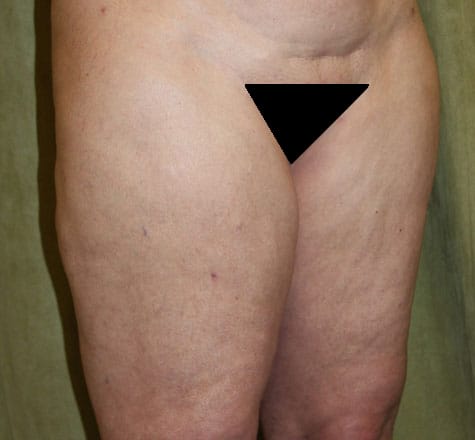 Plastic surgery patient results gallery - Dr. Cat Beverly Hills
