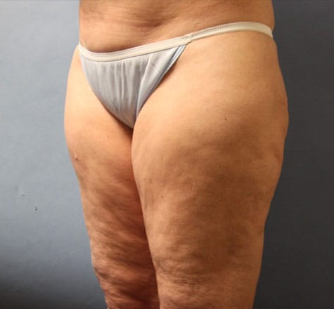 Plastic surgery patient results gallery - Dr. Cat Beverly Hills