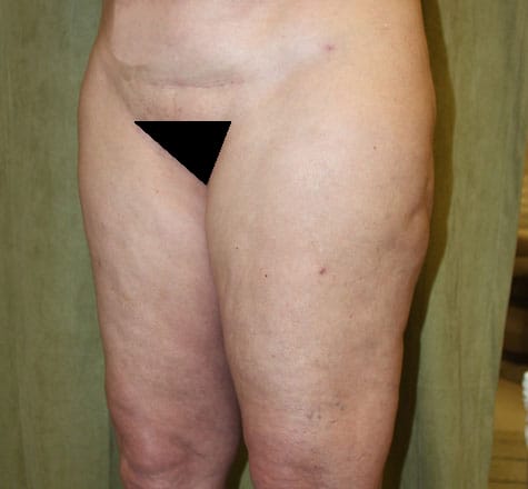 Plastic surgery patient results gallery - Dr. Cat Beverly Hills