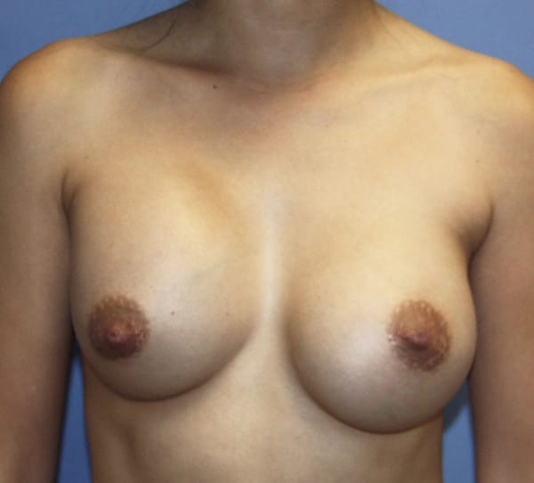 Plastic surgery patient results gallery - Dr. Cat Beverly Hills