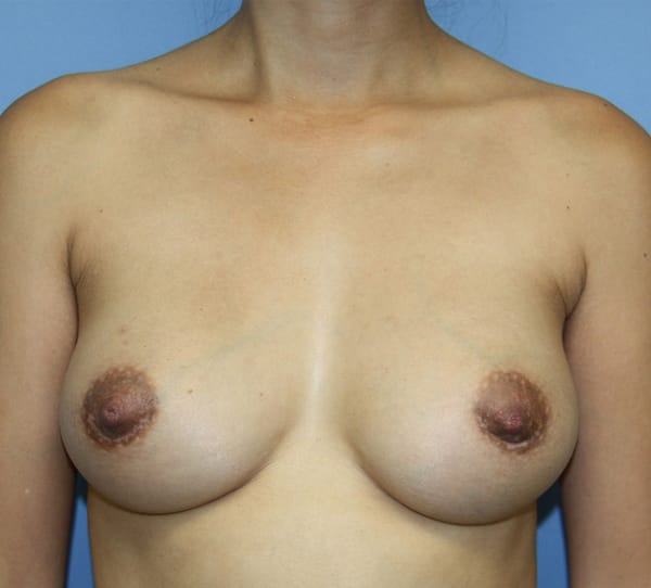 Plastic surgery patient results gallery - Dr. Cat Beverly Hills