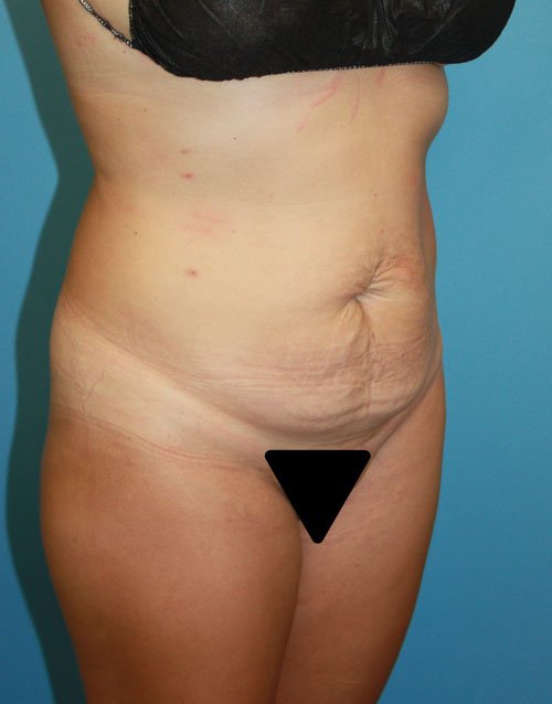 Plastic surgery patient results gallery - Dr. Cat Beverly Hills