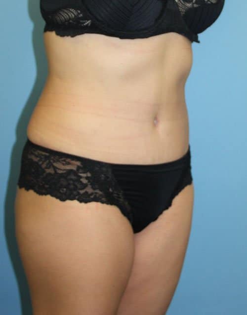 Plastic surgery patient results gallery - Dr. Cat Beverly Hills