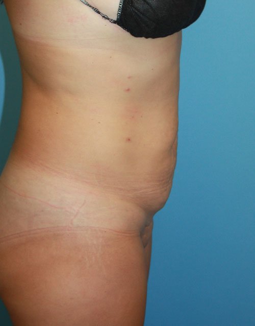Plastic surgery patient results gallery - Dr. Cat Beverly Hills