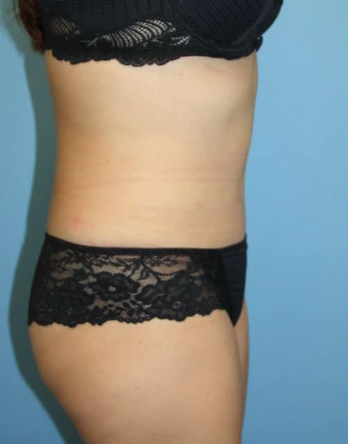 Plastic surgery patient results gallery - Dr. Cat Beverly Hills